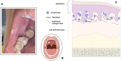 Lichen sclerosus of the oral mucosa: a hidden phenomenon